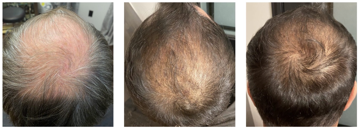 Before-and-after progression of a male client's crown showing restored density