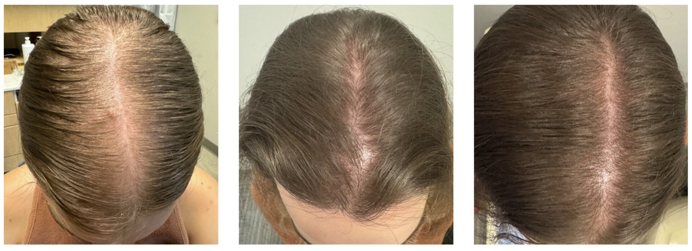 Three-stage progression of a client's part line showing increasing hair density